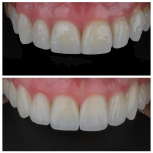 Dantų laminatės prieš ir po gydymo