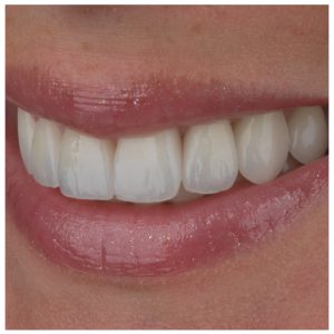 Dantų laminatės venyrai