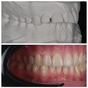 Dantys prieš breketus ir po jų