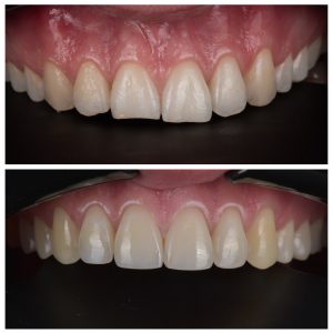 Dantys prieš ir po estetinio plombavimo