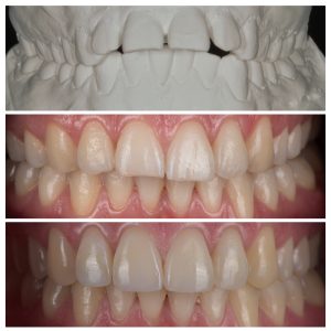 Dantys prieš ir po gydymo beligatūriniais breketais