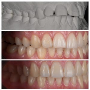 Dantys prieš ir po tiesinimo beligatūriniais breketais