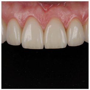 Laminatės ant priekinių dantų