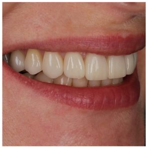 Laminatės ir karūnėlės ant pacientės dantų