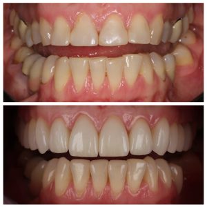 Pacientės dantys prieš ir po kompleksinio gydymo