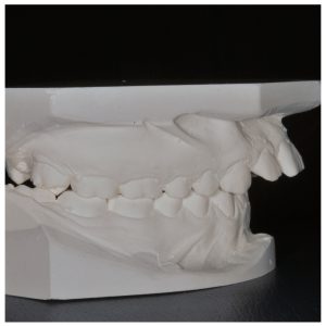 Paciento dantų modelis su protruzija