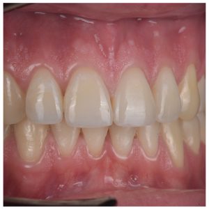 Paciento dantys po tiesinimo breketais