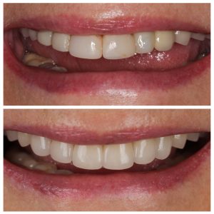 Priekiniai cirkonio dantys prieš ir po