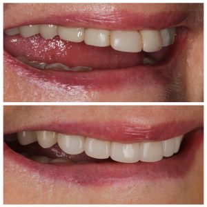 Šoniniai cirkonio dantys prieš ir po