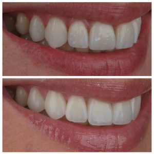 Venyrai prieš ir po