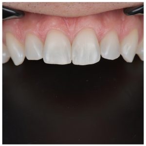 6 priekinių dantų estetinis plombavimas