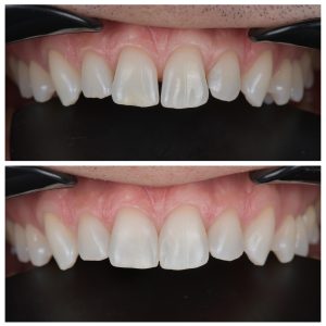 6 priekinių dantų estetinis plombavimas prieš ir po