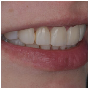 Dantys po gydymo kapomis