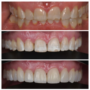Dantys prieš ir po dantų tiesinimo