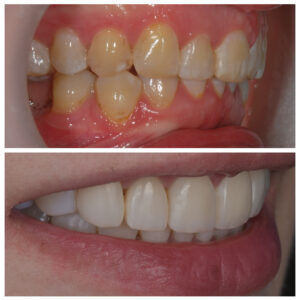 Dantys prieš it po kapų