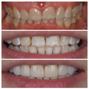 Pacientės dantys prieš ir po gydymo kapomis