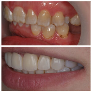 Pacientės dantys prieš ir po ortodontinio gydymo