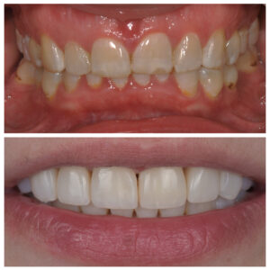 Šypsena prieš ir po ortodontinio gydymo