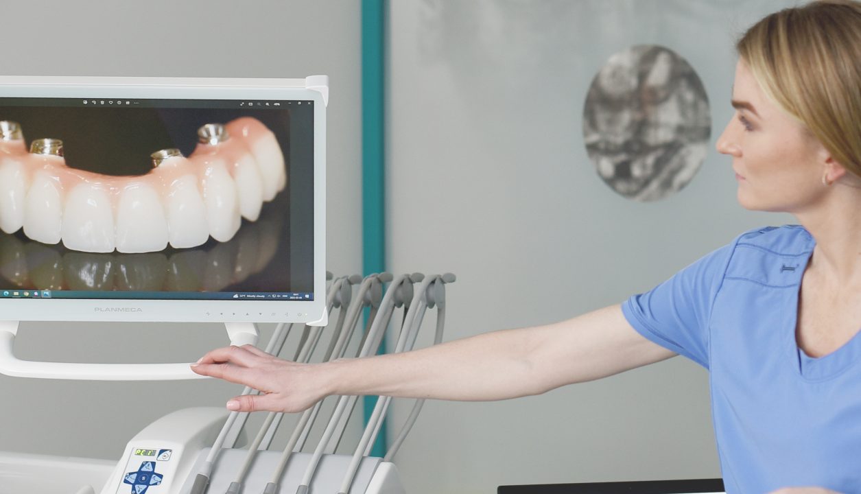 All on four dantų implantacijos konsultacija su odontologe Egle