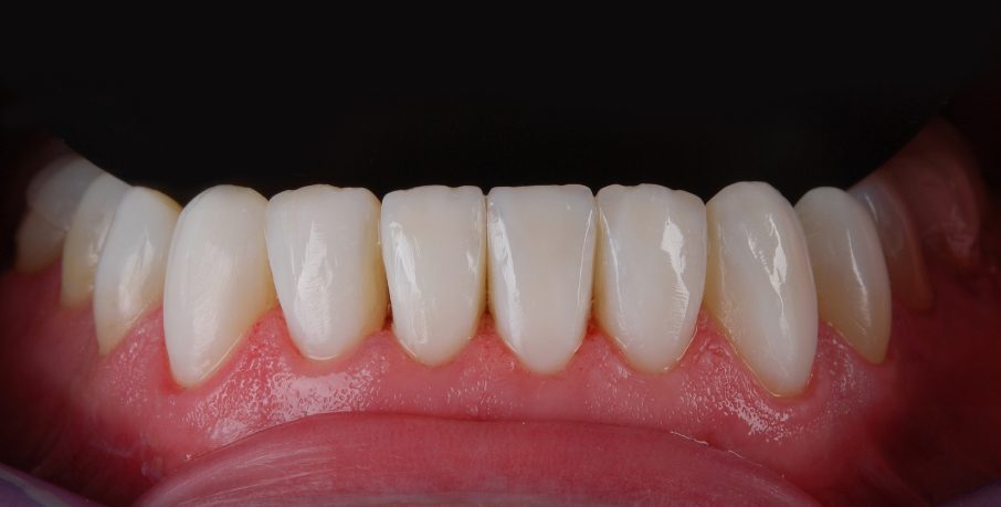 Apatiniai priekiniai dantys po estetinio plombavimo