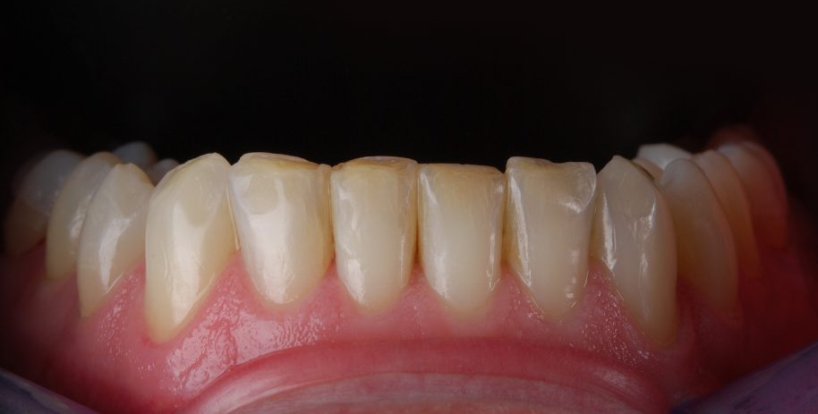 Apatiniai priekiniai dantys prieš estetinį plombavimą