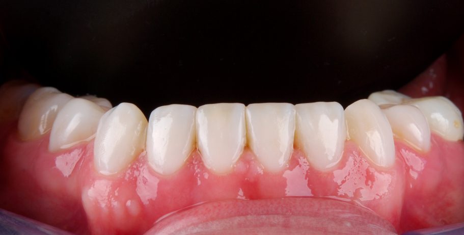 Apatinių dantų nuotrauka po estetinio plombavimo