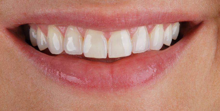 Burnos dantų estetinis plombavimas prieš