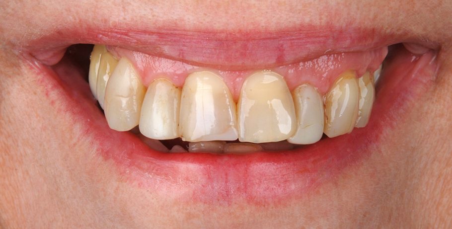 Dantų estetinis tvarkymas su dantų laminatėmis prieš