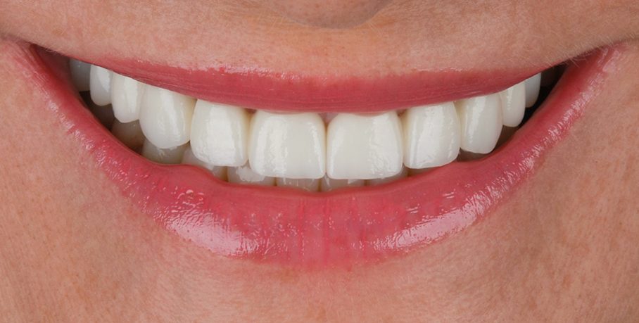 Dantų implantai dantys po implantacijos