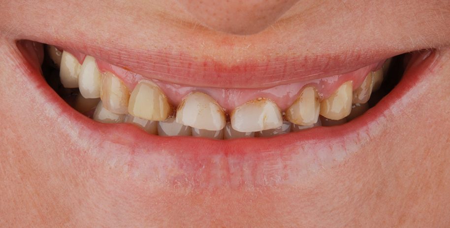 Dantų implantai dantys prieš implantaciją