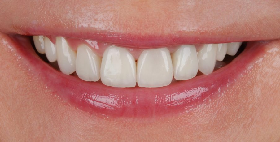 Dantų implantai po procedūros