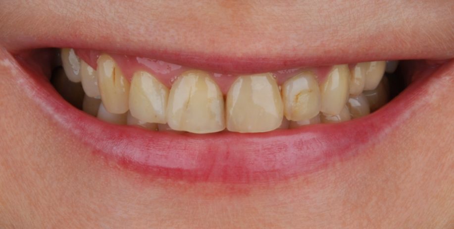 Dantų implantai prieš procedūrą