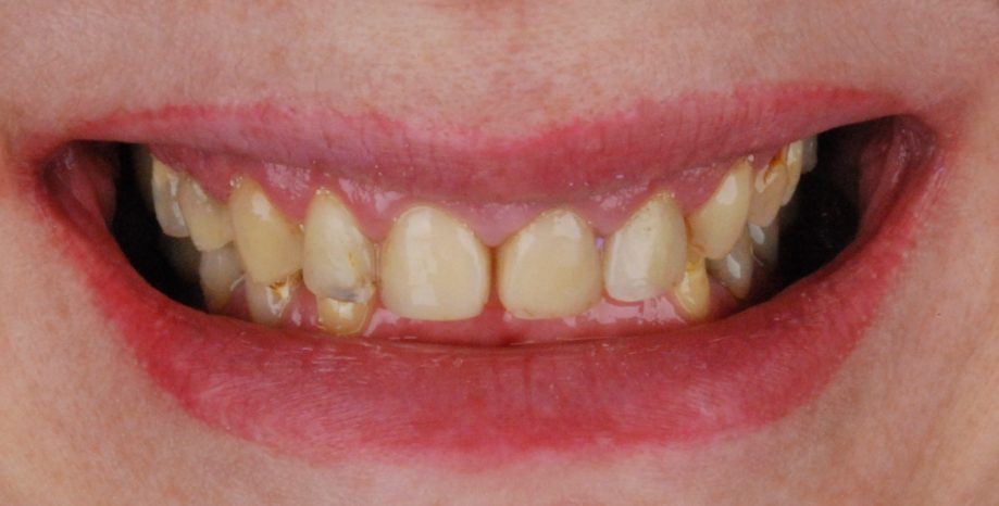 Dantų protezavimas prieš