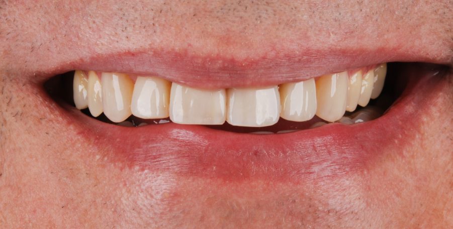 Dantų tiesinimas paciento dantys po