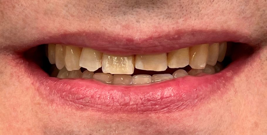 Dantų tiesinimas paciento dantys prieš