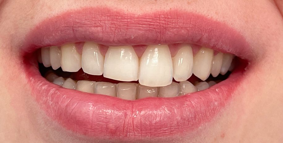 Estetinis plombavimas bei dantų balinimas šypsena prieš