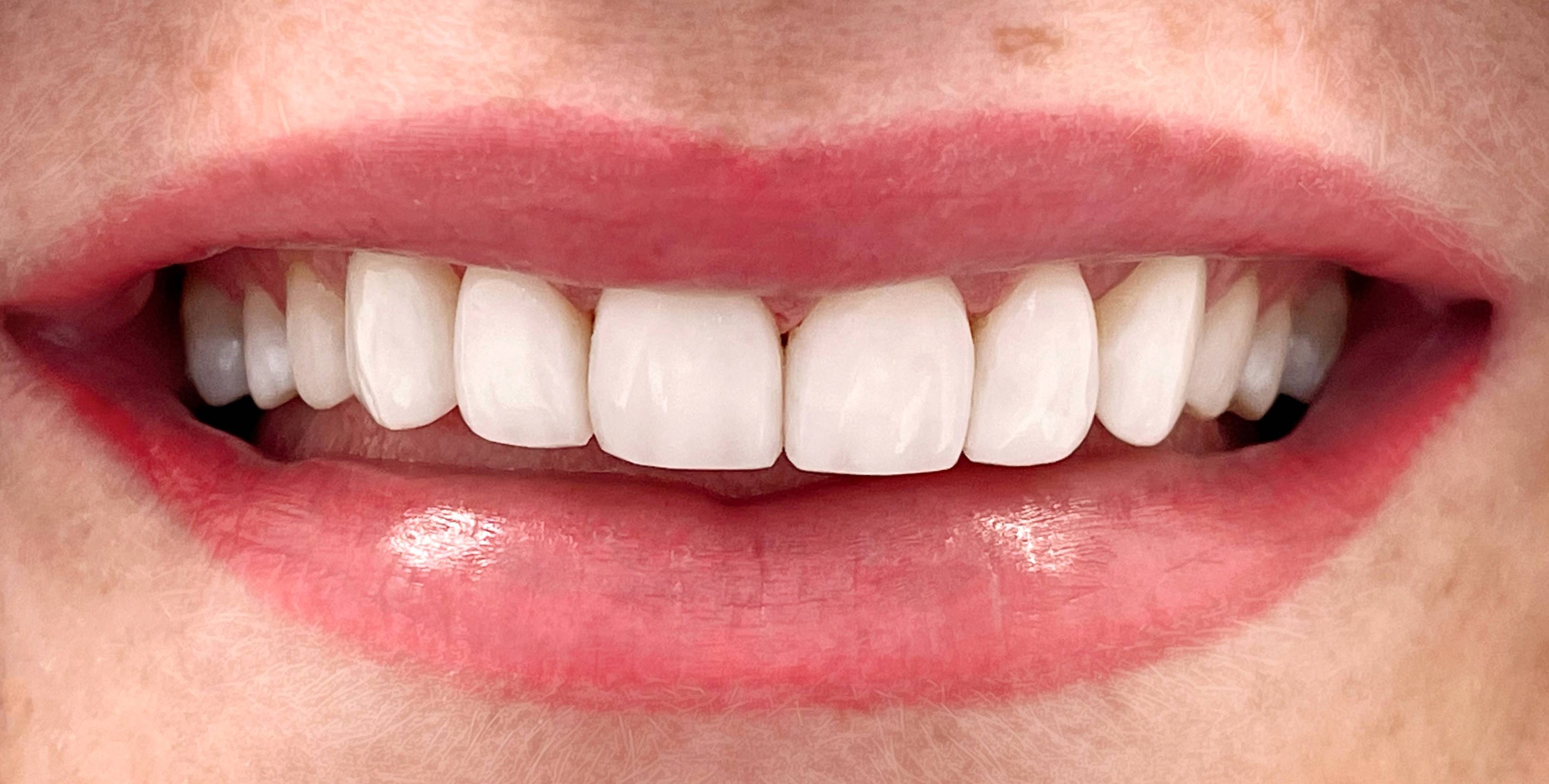 Klientės dantys burnoje po estetinio plombavimo