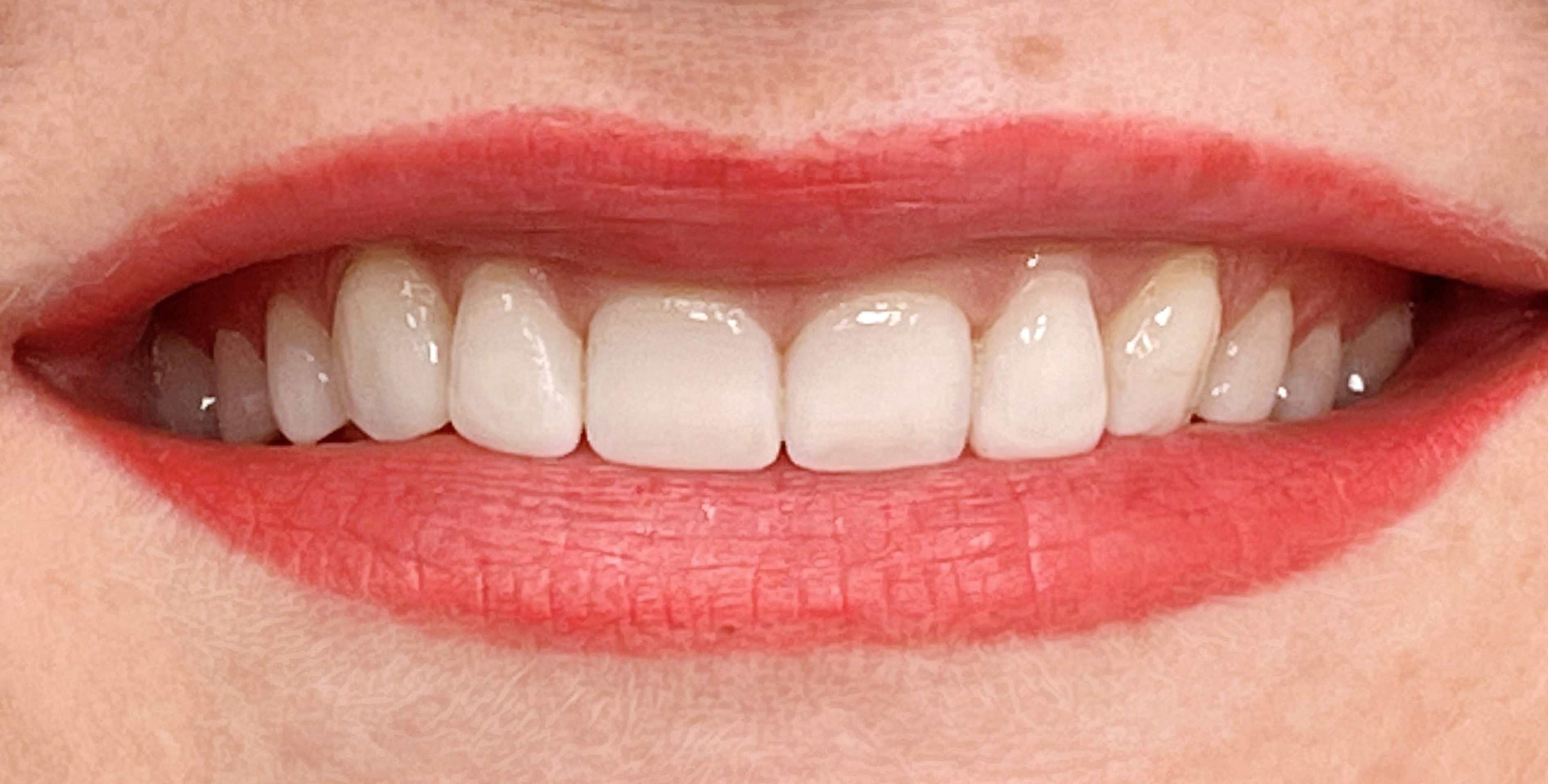 Klientės dantys burnoje prieš estetinį plombavimą