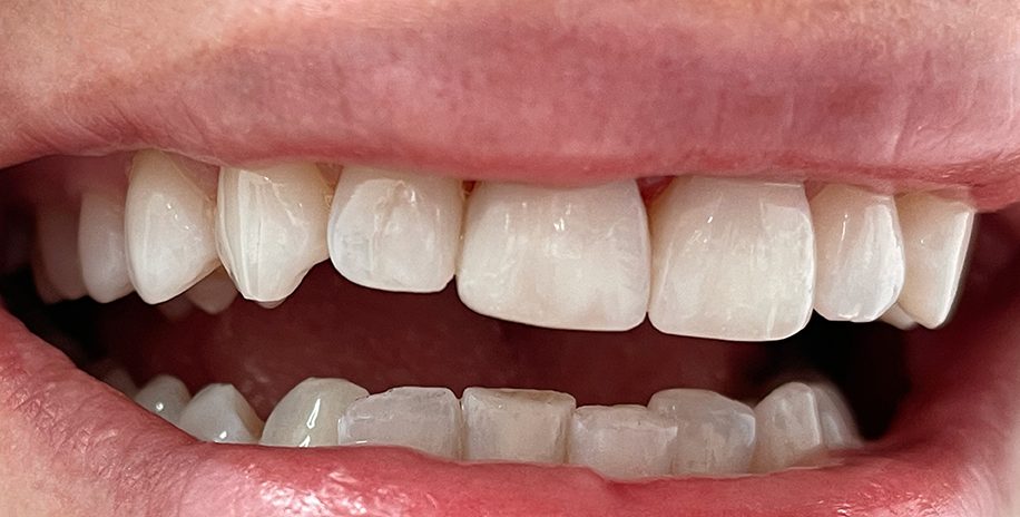 Kliento dantų nuotrauka po estetinio plombavimo