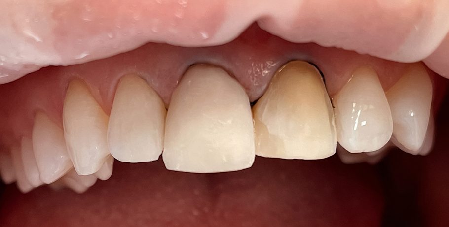 Kliento dantų nuotrauka prieš estetinį plombavimą