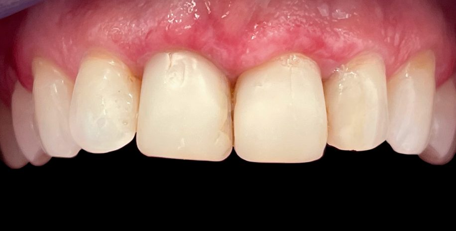 Paciento dantys prieš estetinį plombavimą