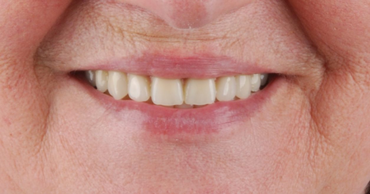 Šypsena su dantų implantais