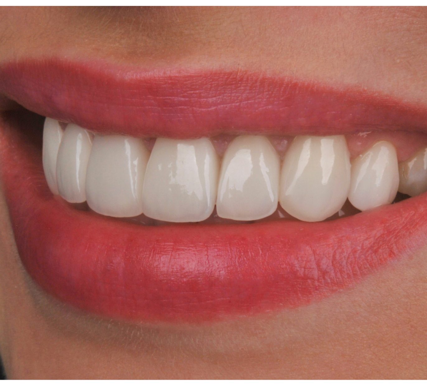 Šypsena po gydymo kurį sudaro dantų laminatės