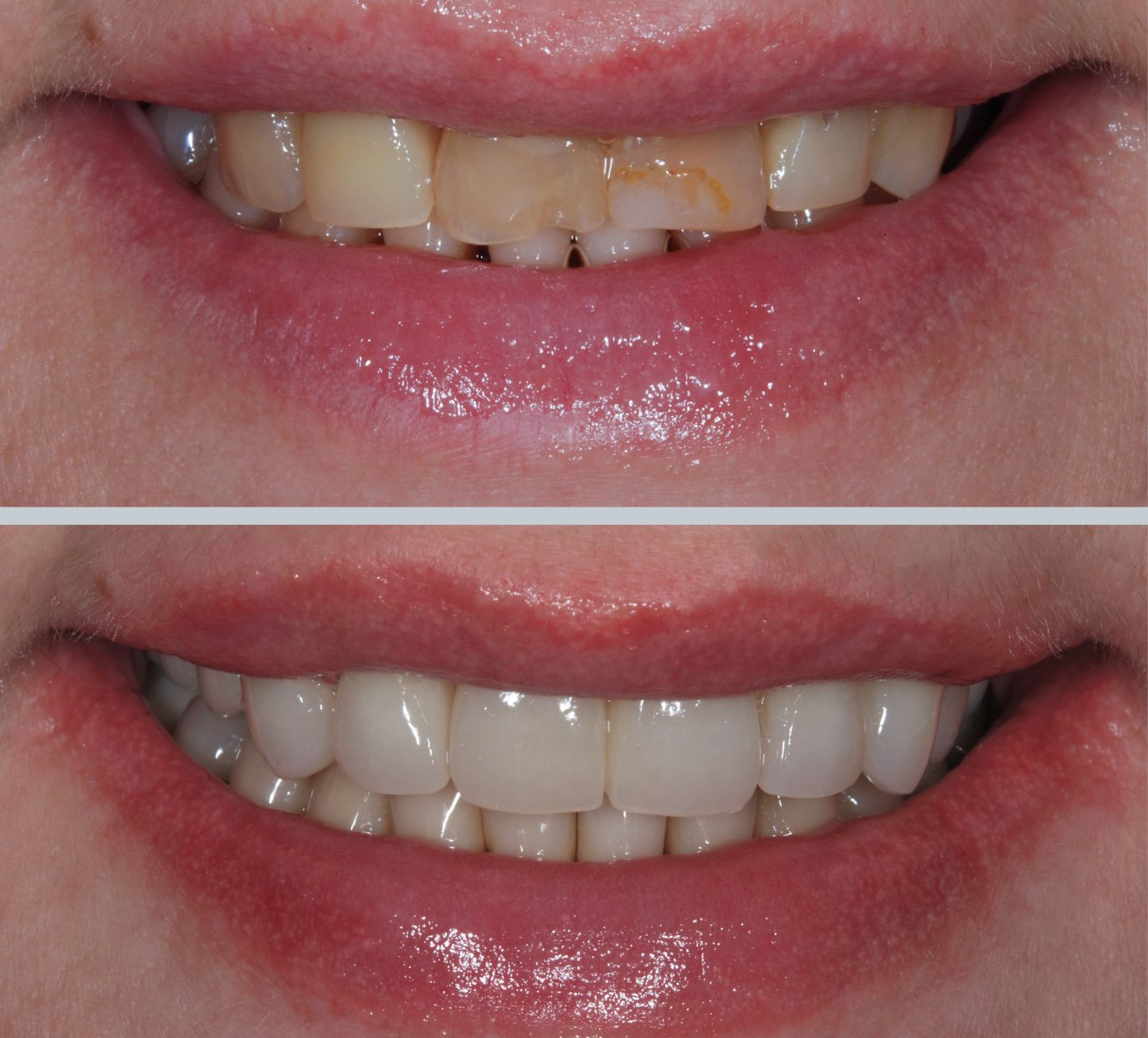 Dantų karūnėlės ant pacientės dantų prieš ir po gydymo