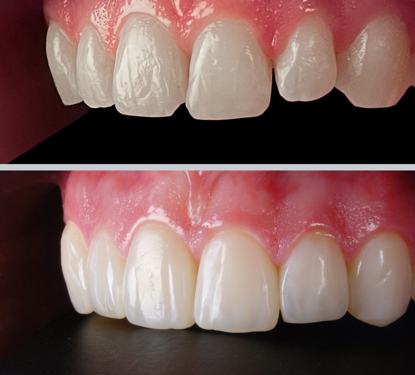 Estetinis plombavimas Kaune prieš ir po