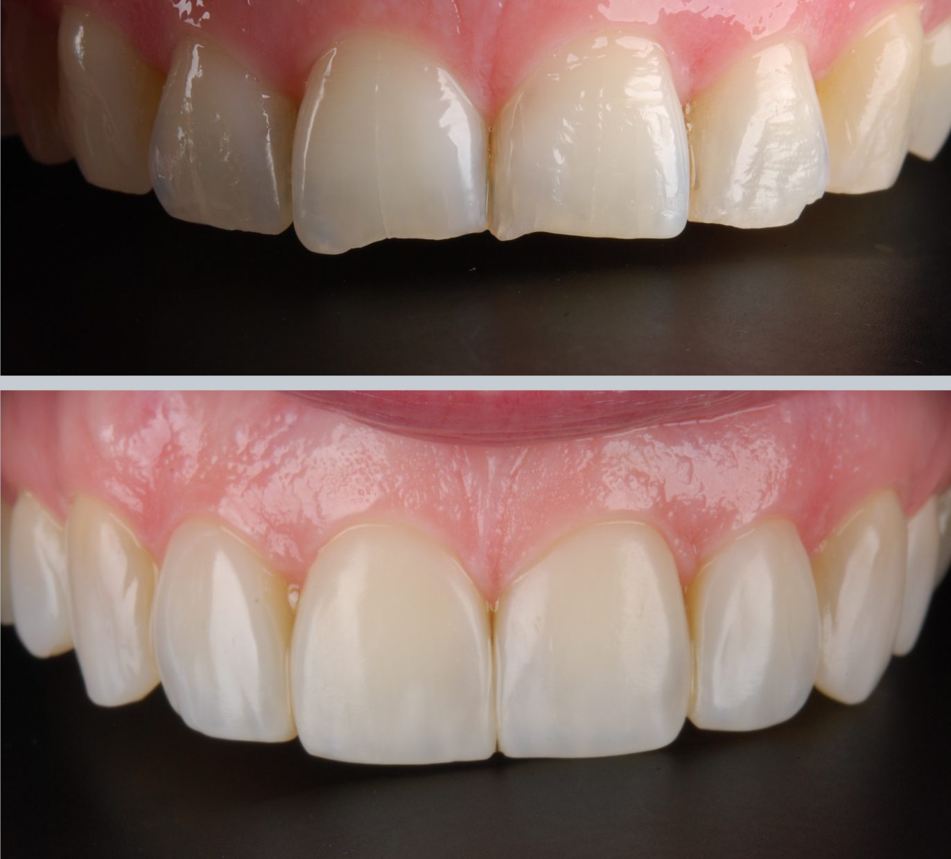 Kompleksinis gydymas ir estetinis plombavimas prieš ir po