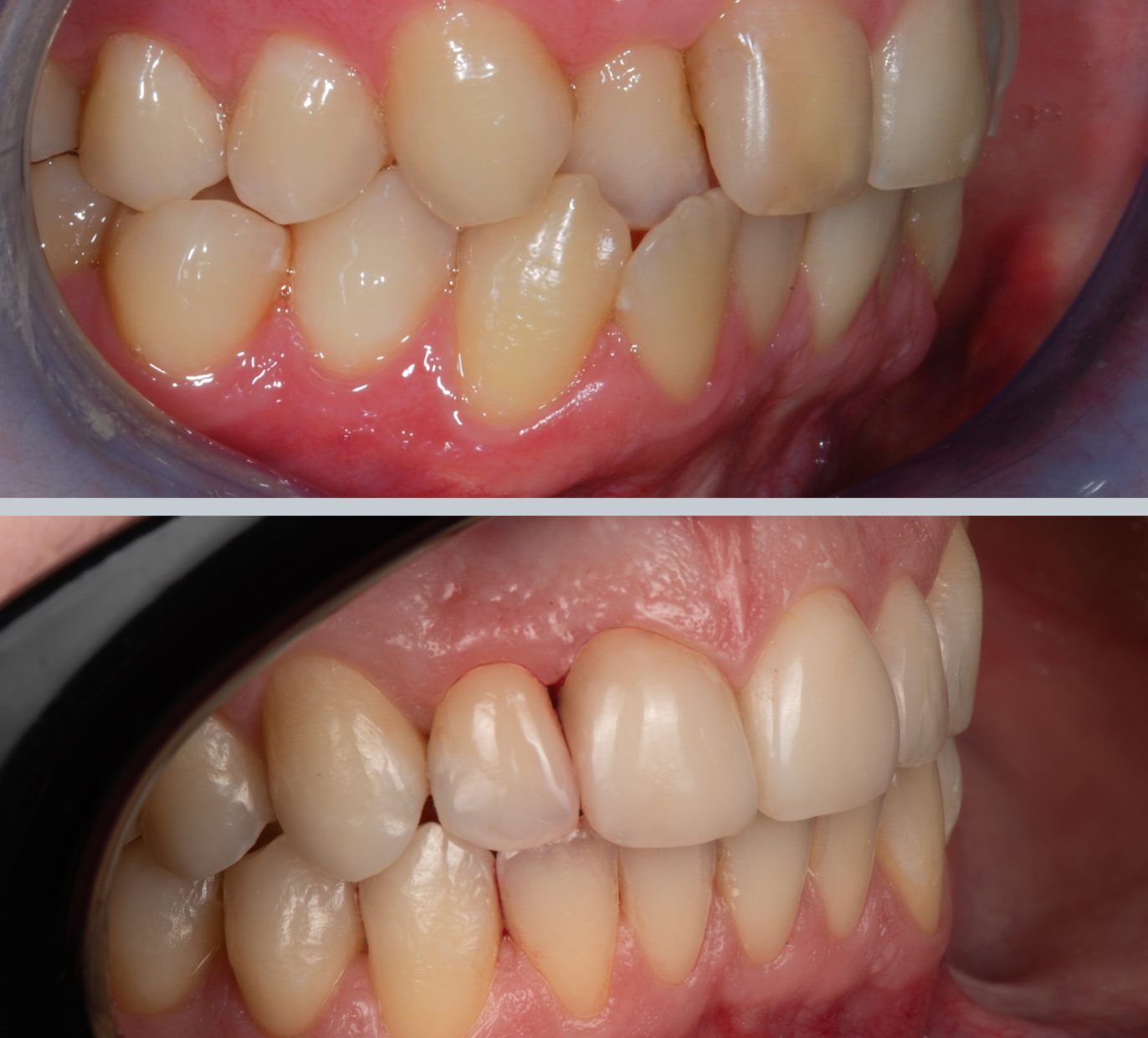 Netaisyklingas sąkandis iš šono prieš ir po kompleksinio gydymo