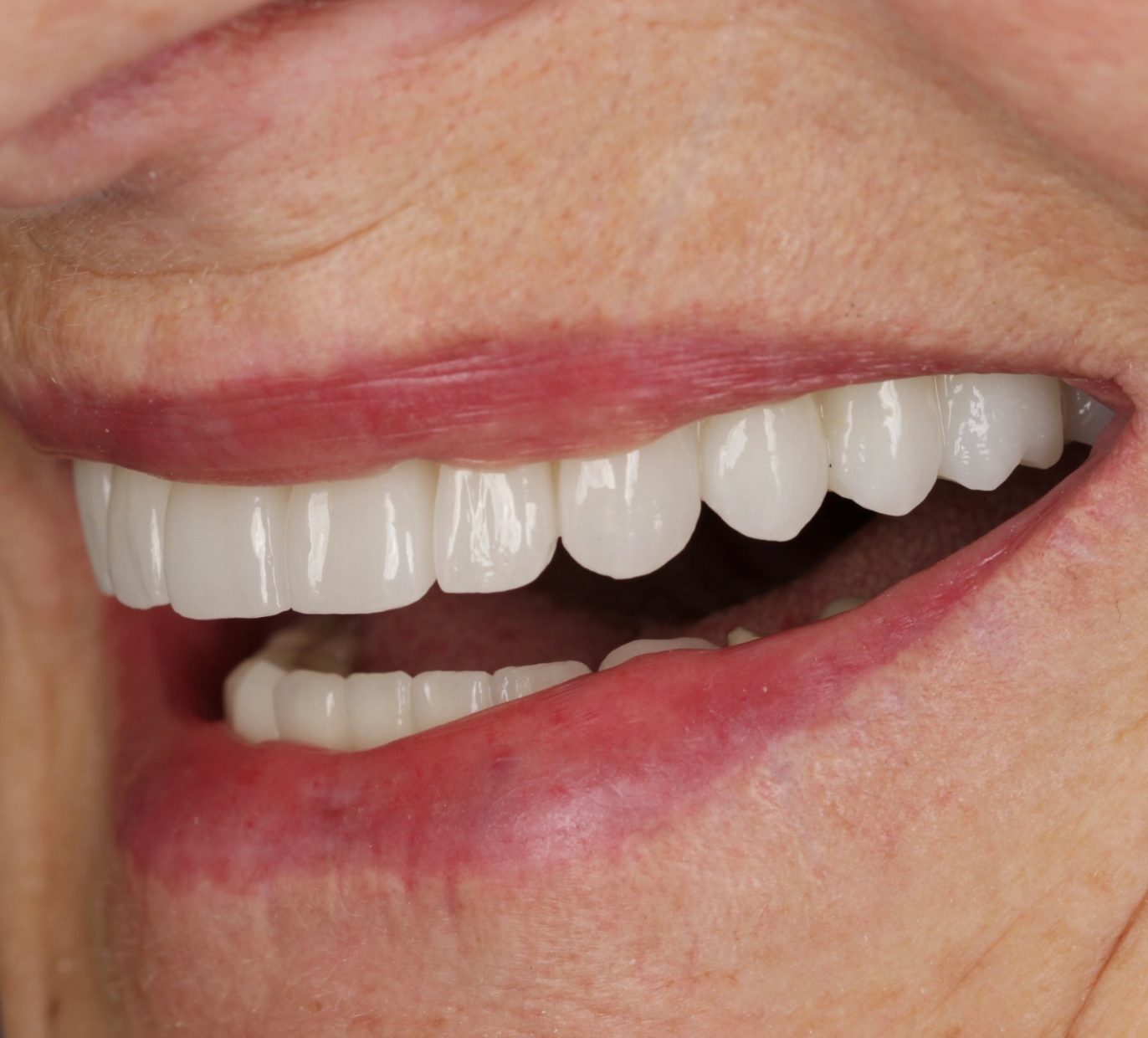 Šypsena ir All-on-6 implantai