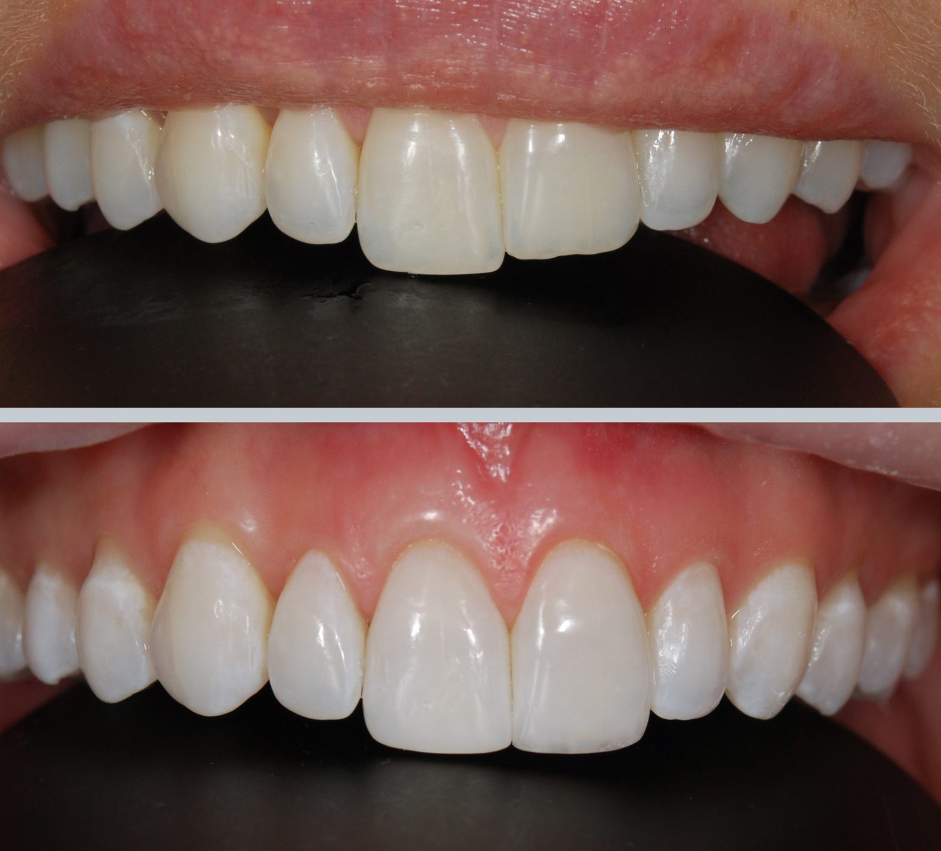 Vieno danties estetinis plombavimas po dantų tiesinimo prieš ir po