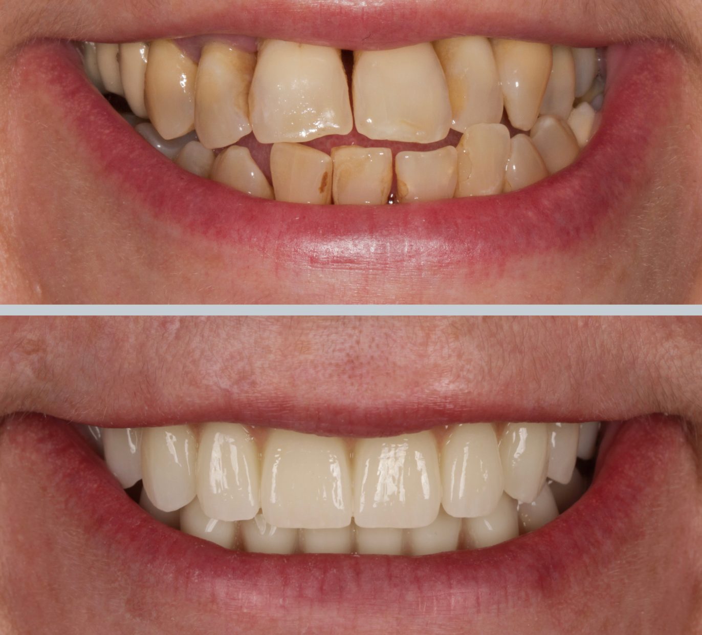 Dantys prieš ir po gydymo All-on-4 ir All-on-6